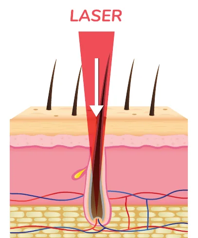 Minh hoạ trong chương “Các liệu pháp điều trị khác Dược mỹ phẩm peel da laser” — sách Hiểu mụn để hết mụn