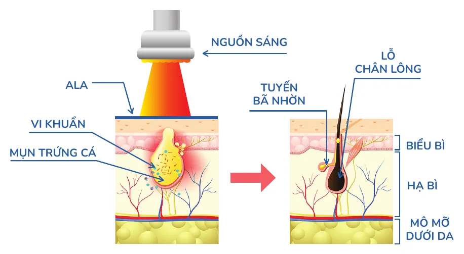 Minh hoạ trong chương “Các liệu pháp điều trị khác Dược mỹ phẩm peel da laser” — sách Hiểu mụn để hết mụn