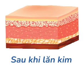 Minh hoạ trong chương “Cách ngăn ngừa và điều trị sẹo mụn” — sách Hiểu mụn để hết mụn