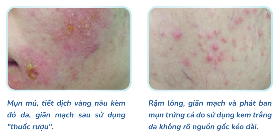 Minh hoạ trong chương “Chăm sóc và phục hồi tình trạng viêm da do corticoid” — sách Hiểu mụn để hết mụn