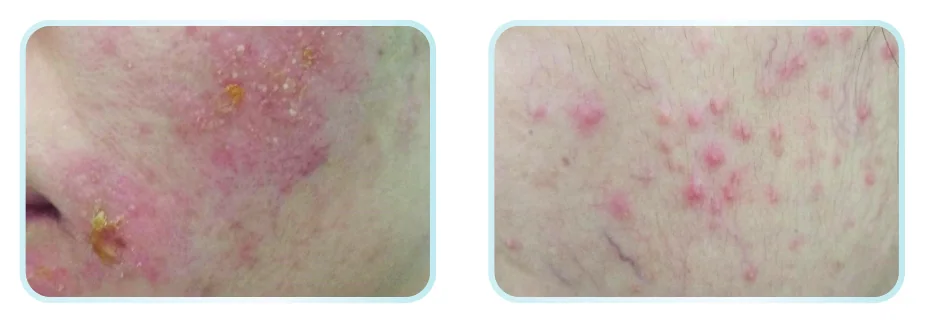 Minh hoạ trong chương “Chăm sóc và phục hồi tình trạng viêm da do corticoid” — sách Hiểu mụn để hết mụn