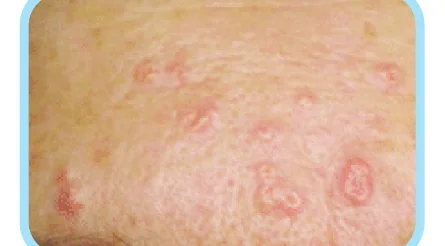 Minh hoạ trong chương “Chín tình trạng giống mụn, nhưng không phải mụn” — sách Hiểu mụn để hết mụn