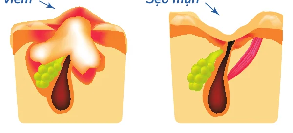 Minh hoạ trong chương “Mụn nào sẽ để lại sẹo” — sách Hiểu mụn để hết mụn