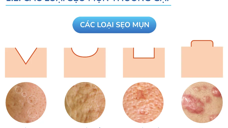 Minh hoạ trong chương “Mụn nào sẽ để lại sẹo” — sách Hiểu mụn để hết mụn