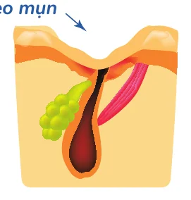Minh hoạ trong chương “Mụn nào sẽ để lại sẹo” — sách Hiểu mụn để hết mụn