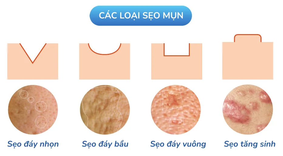 Minh hoạ trong chương “Mụn nào sẽ để lại sẹo” — sách Hiểu mụn để hết mụn
