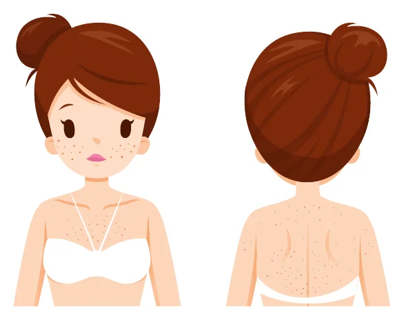 Minh hoạ trong chương “Nhận diện những loại mụn thường gặp” — sách Hiểu mụn để hết mụn