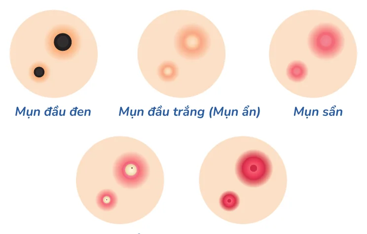 Minh hoạ trong chương “Nhận diện những loại mụn thường gặp” — sách Hiểu mụn để hết mụn
