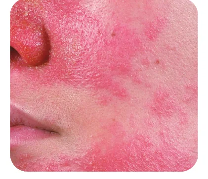 Minh hoạ trong chương “Phân biệt hiện tượng dị ứng, đẩy mụn (khi điều trị) và bùng phát mụn” — sách Hiểu mụn để hết mụn
