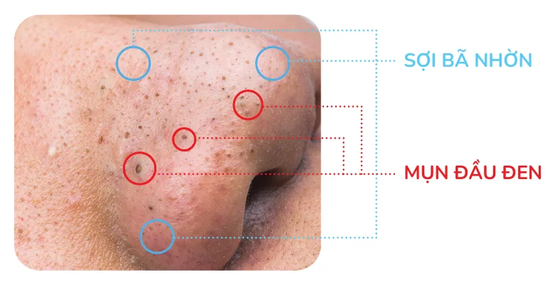 Minh hoạ trong chương “Phân biệt mụn đầu đen, sợi bã nhờn và trichostasis spinulosa” — sách Hiểu mụn để hết mụn