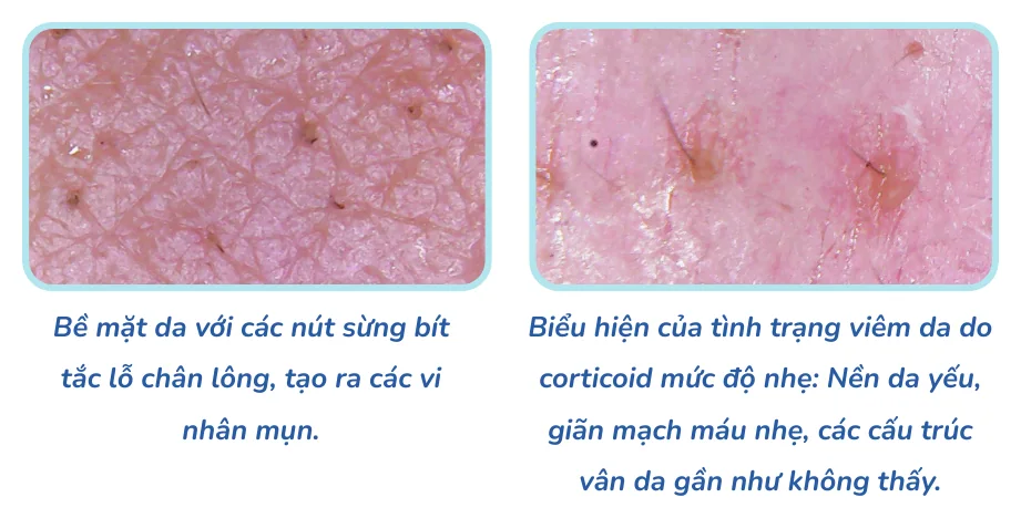 Minh hoạ trong chương “Thấy gì khi soi da” — sách Hiểu mụn để hết mụn