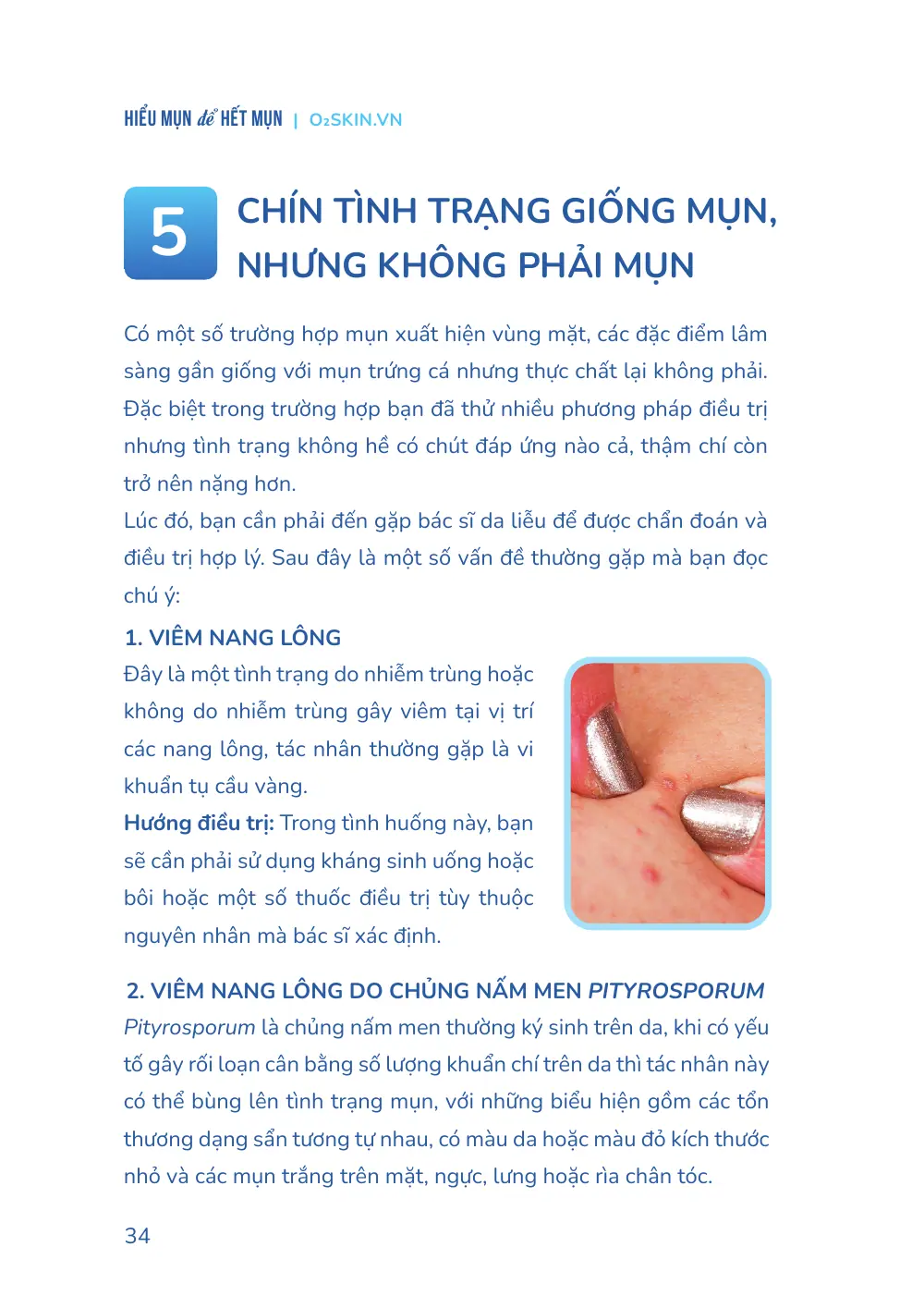 Trang 034 bản in của sách Hiểu mụn để hết mụn
