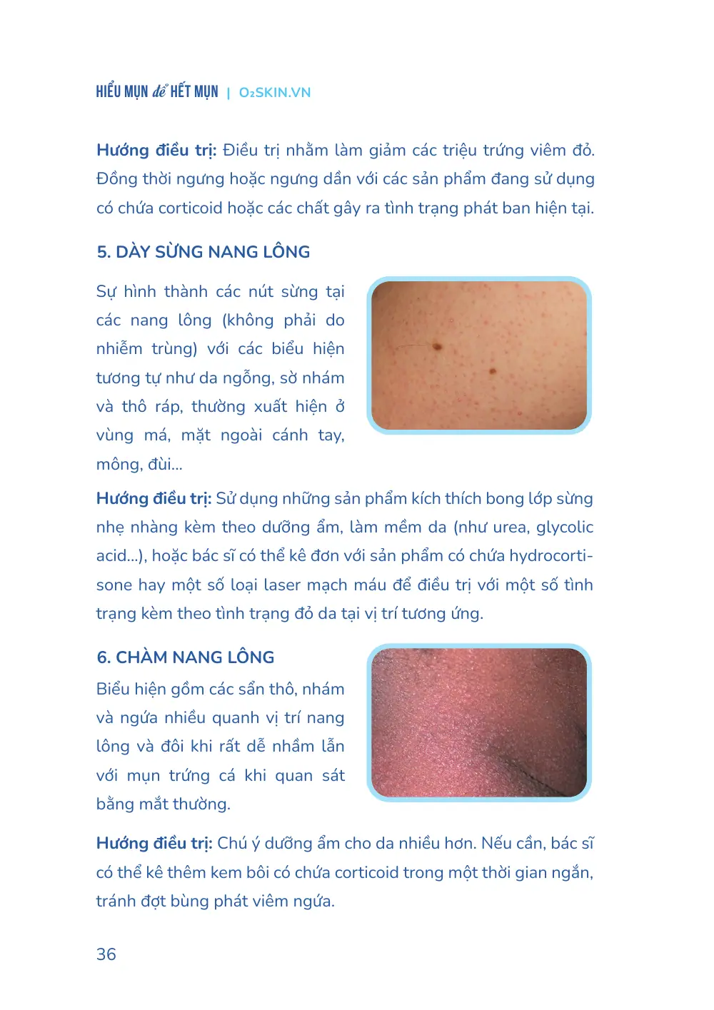 Trang 036 bản in của sách Hiểu mụn để hết mụn