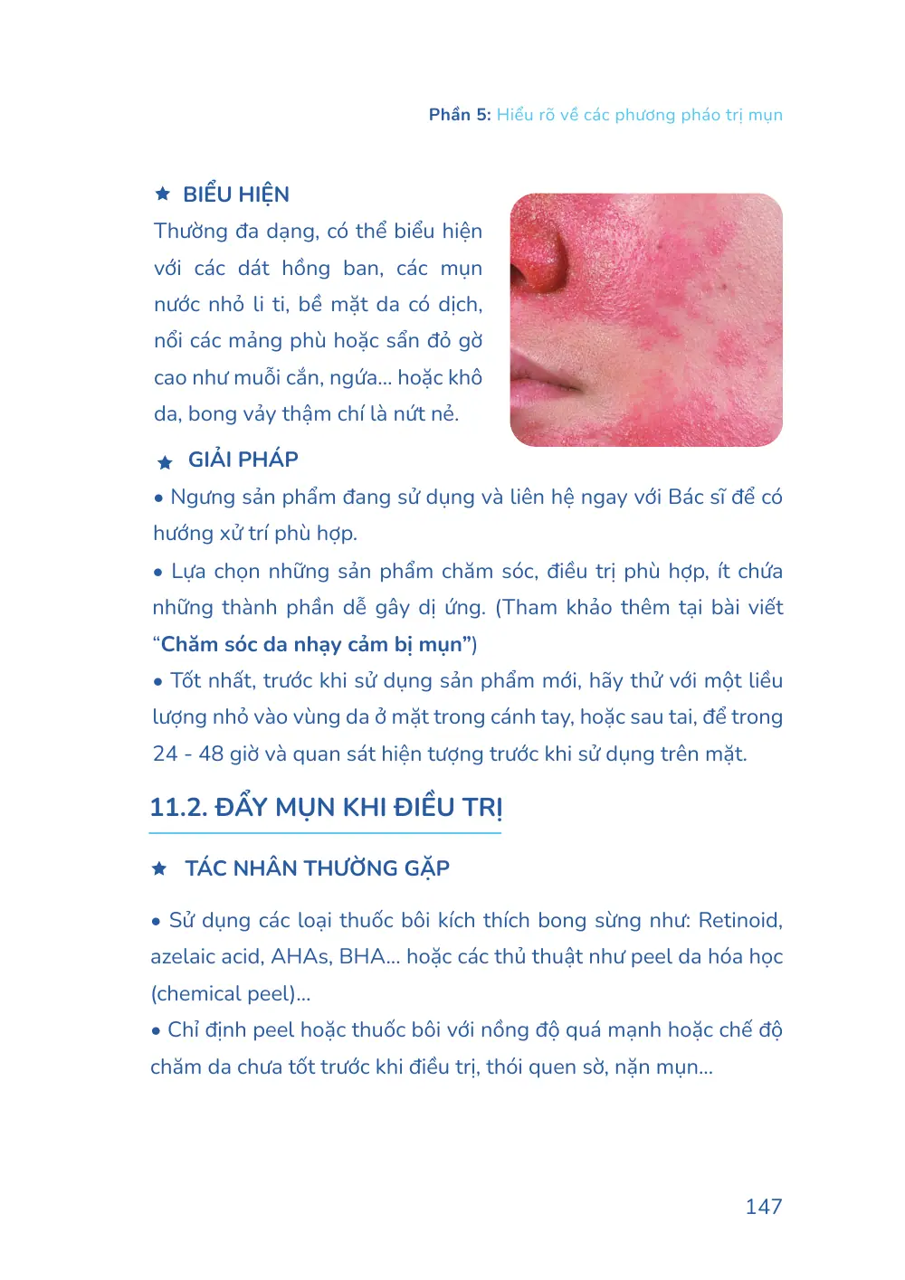 Trang 147 bản in của sách Hiểu mụn để hết mụn