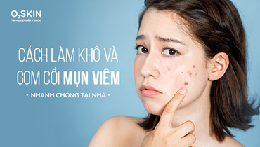 Cách Làm Khô Và Gom Cồi Mụn Viêm Nhanh Chóng Tại Nhà