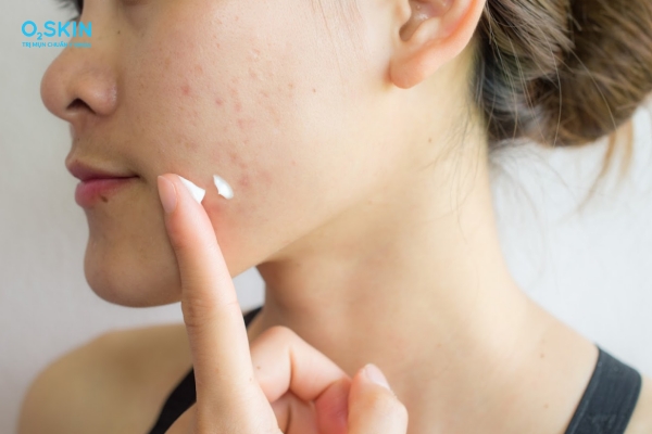 Cách trị mụn bọc không đầu