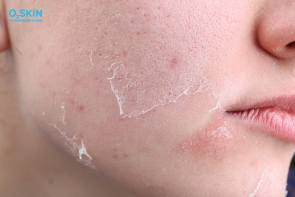 Hiện tượng thường gặp sau peel da