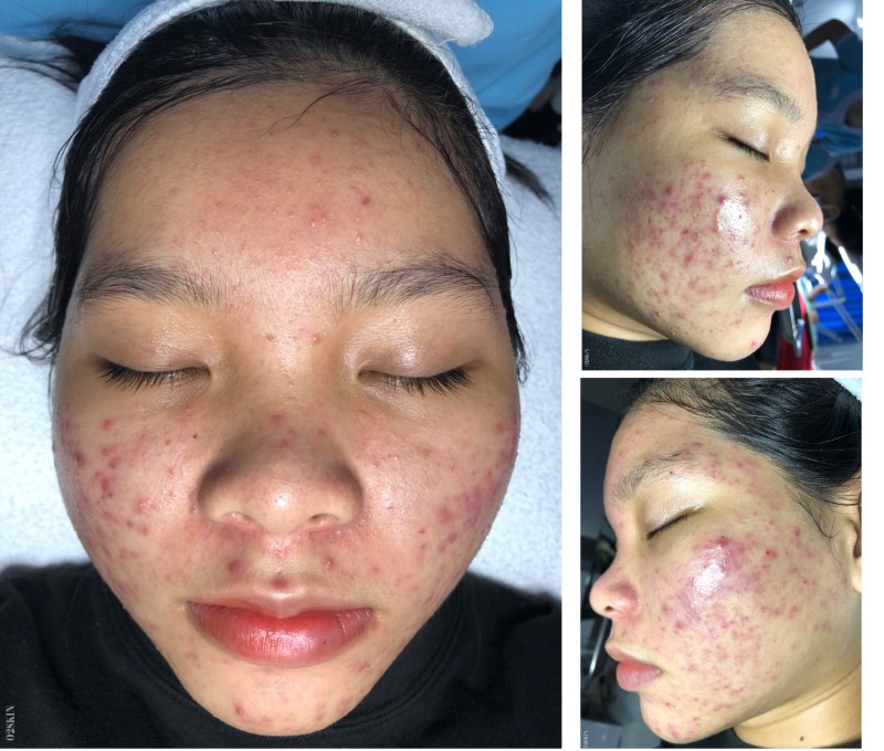 Tình trạng da trước khi điều trị tại O2 SKIN