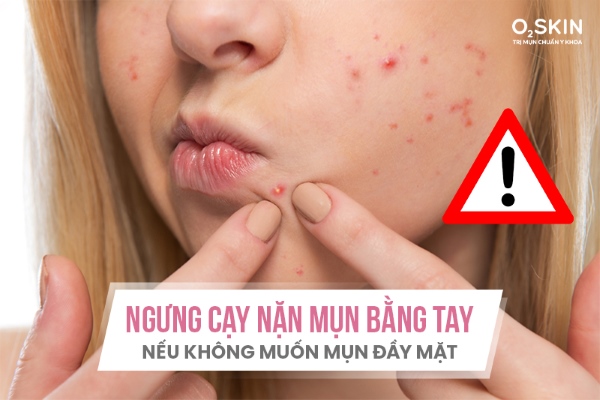 Không cạy, nặn mụn vì sẽ gây viêm nhiễm, mụn lây lan khiến việc điều trị mụn kéo dài.