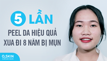 5 Lần Peel Da Hiệu Quả - Xua Đi 8 Năm Bị Mụn