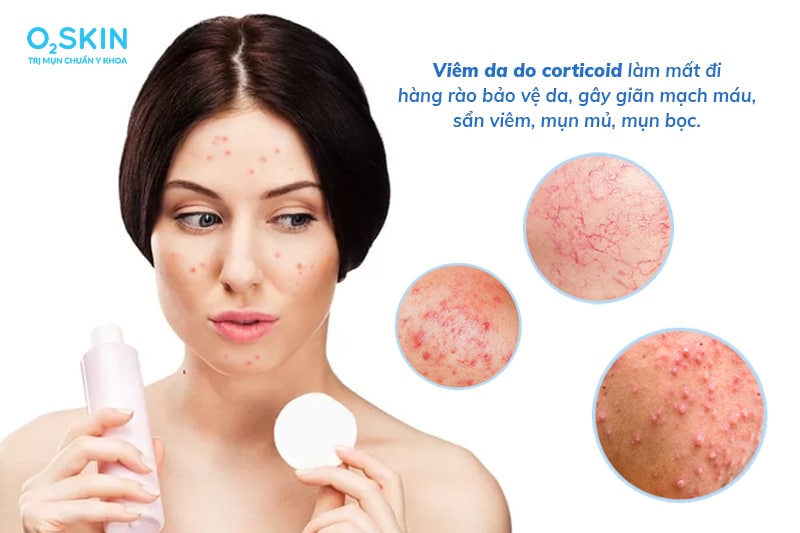 Sản phẩm trị mụn không có nguồn gốc rõ ràng, chứa corticoid và các chất cấm