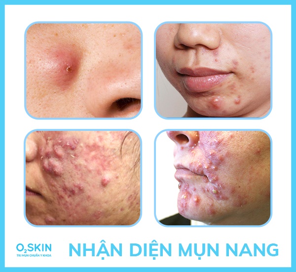 Mụn nang thường sưng to, bên trong có nhiều dịch mủ, gây đau đớn.