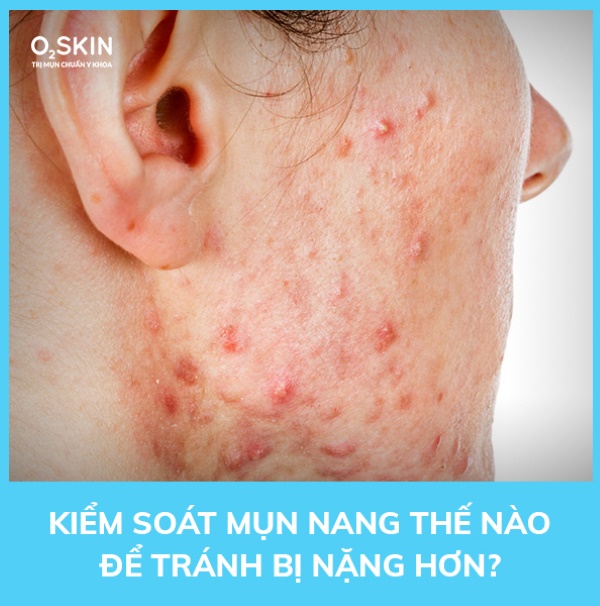 Kiểm soát sai lầm thường gặp là cách đơn giản giúp tránh mụn nang trầm trọng hơn.