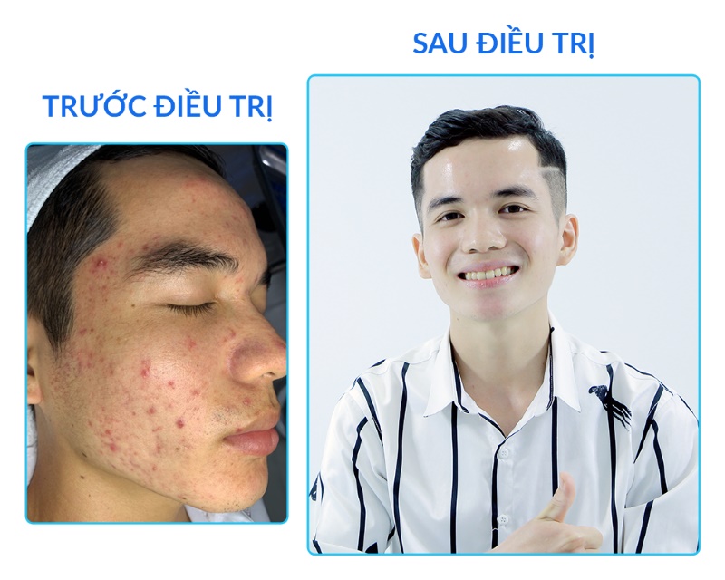 Gia Bảo - Cải Thiện Diện Mạo Sau Thời Gian Ngắn Tái Khám Đều Đặn Cùng Bác Sĩ Tại O2 skin.