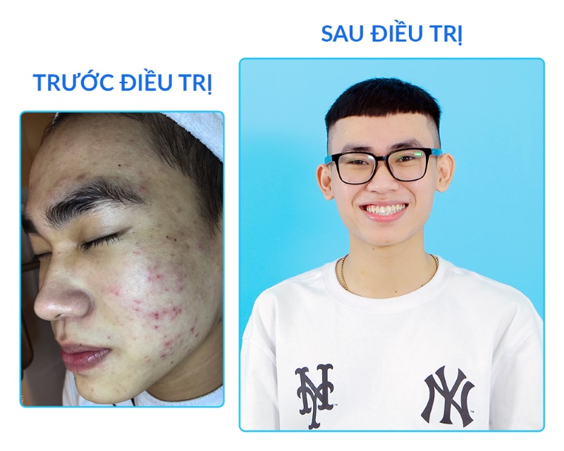 Thừa Đức Cải Thiện 90% Da Mụn Sau 1 Tháng Trị Mụn Chuẩn Y Khoa Tại O2 SKIN