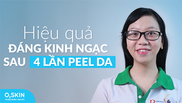 Người Thật Việc Thật - Hiệu Quả Đáng Kinh Ngạc Sau 4 Lần Peel Da