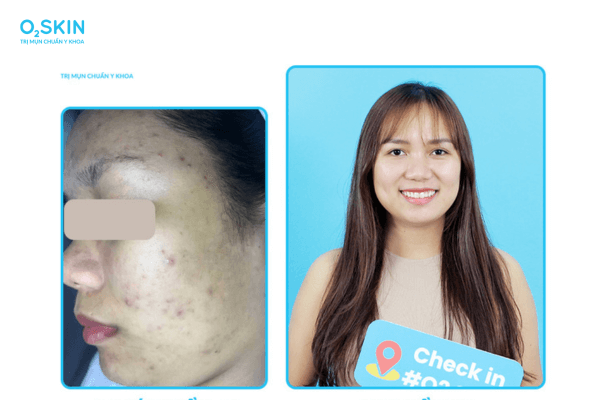 Làn da sau 2 tháng điều trị mụn tại O2 SKIN