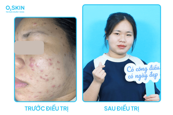 Làn da sau 2 tháng điều trị mụn tại O2 SKIN