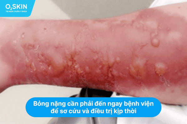 Bỏng nặng cần phải đến ngay bệnh viện để sơ cứu và điều trị kịp thời.