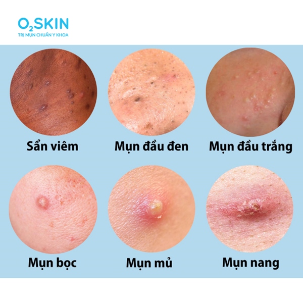 Mụn Mủ Xanh: Nguyên Nhân, Cách Điều Trị Hiệu Quả Và Phòng Ngừa