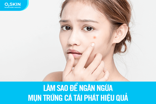 cách ngừa mụn hiệu quả