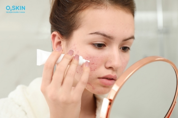 Cách trị mụn bọc sưng to