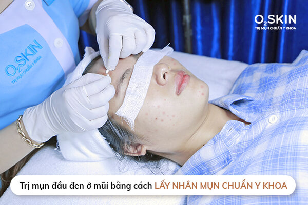 mụn đầu đen mũi