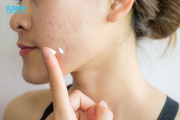 Chăm sóc da mụn đúng cách