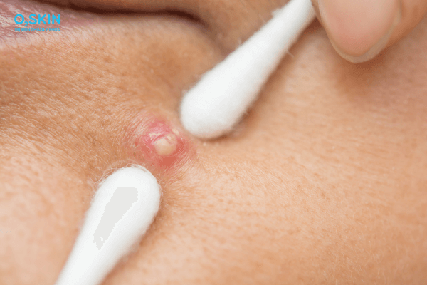 nặn mụn xong có peel da được không