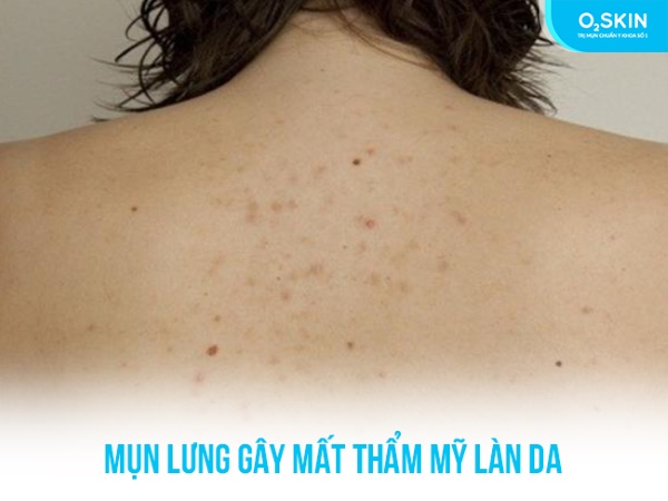 Điều trị mụn lưng uy tín 