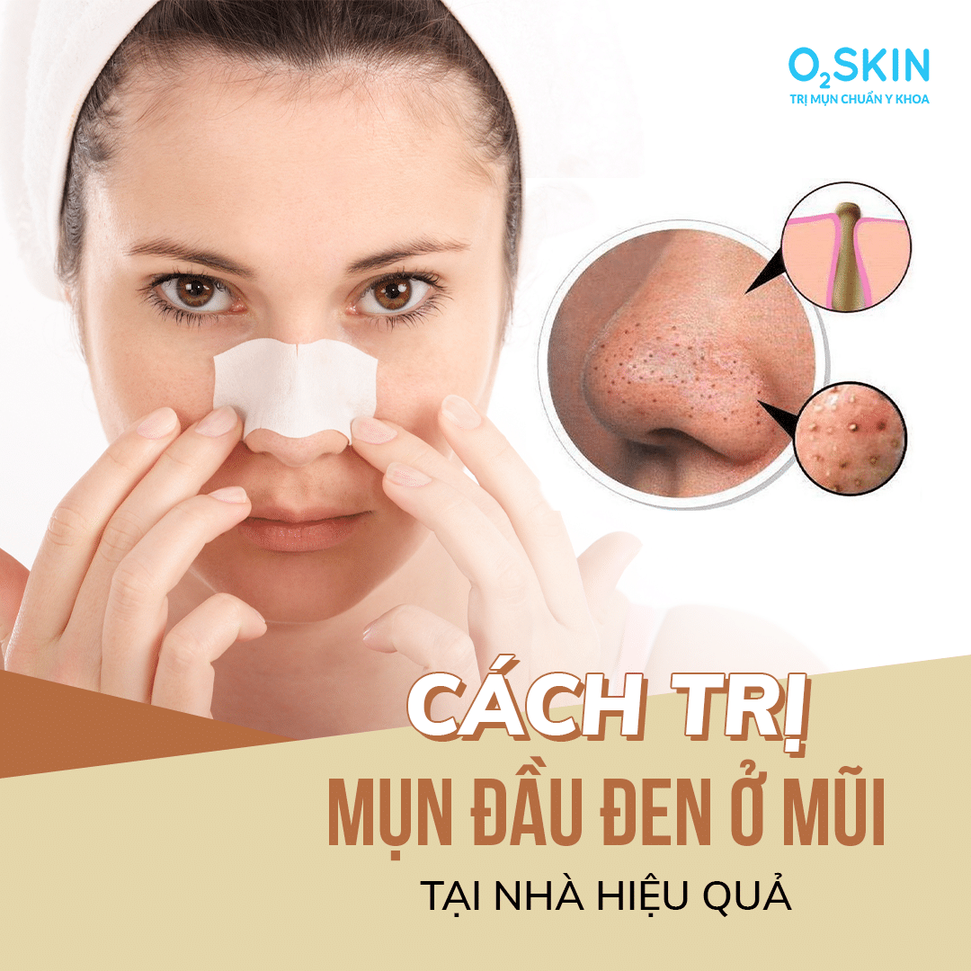 Top 9 cách trị mụn đầu đen ở mũi tại nhà hiệu quả