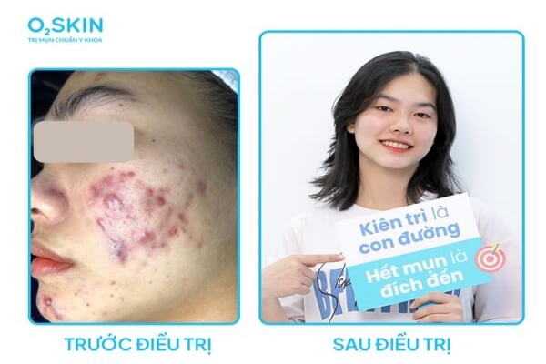 Kết quả điều trị mụn chuyên sâu