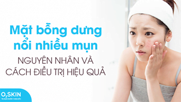 Tìm Hiểu Nguyên Nhân Để Có Phương Pháp Trị Mụn Hiệu Quả