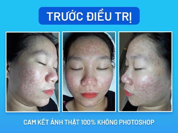 Trước khi điều trị mụn tại O2 SKIN