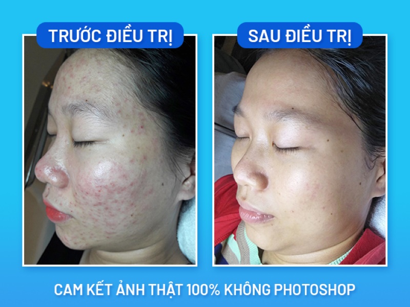 Trước và sau khi điều trị mụn tại O2 SKIN