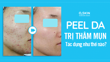 Peel Da Trị Thâm Mụn – Hiệu Quả Và Các Phương Pháp Peel