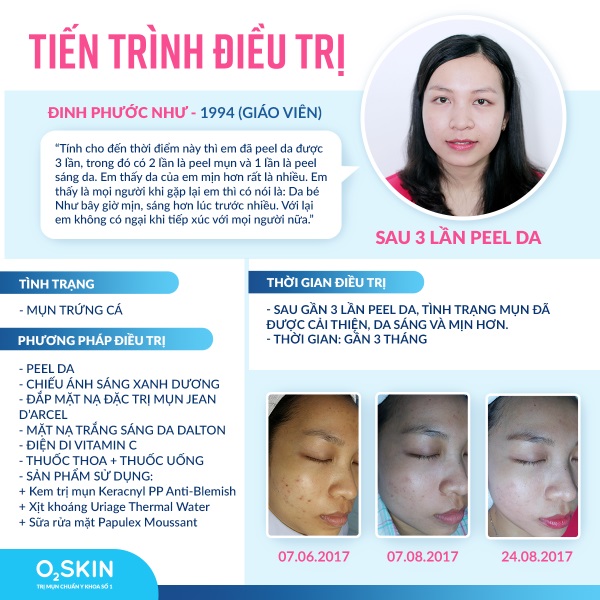 Hiệu quả sau 3 lần Peel da trị thâm mụn tại O2 SKIN