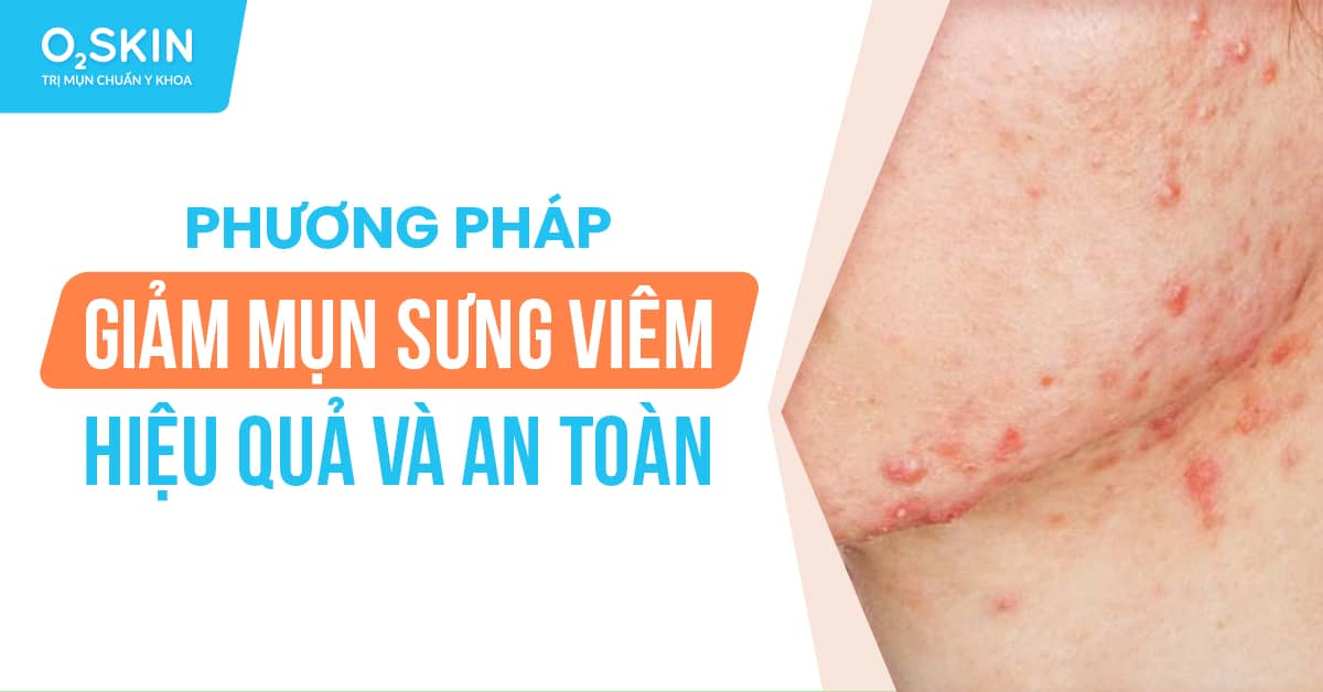 Cách Giảm Mụn Sưng Viêm Hiệu Quả, An Toàn