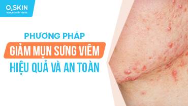 Top 8 Cách Giảm Mụn Sưng Viêm Nhanh, Hiệu Quả, An Toàn