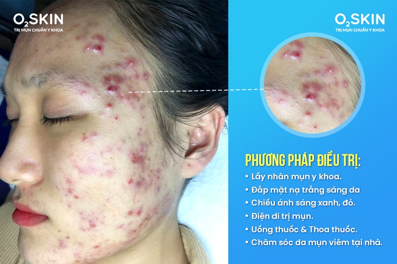 Tình trạng mụn viêm và vết thâm của Diễm trước khi điều trị tại O2 Skin.